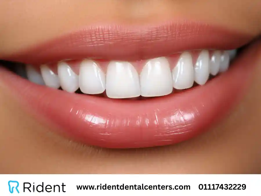 انواع تبييض الاسنان